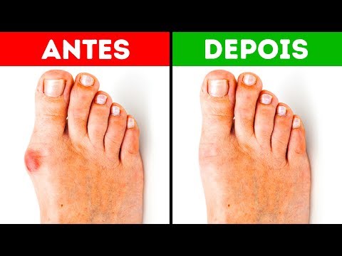 5 Dicas Para Aliviar A Dor No Joanete