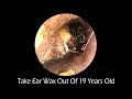 Take Ear Wax Out Of 19 Years Old With Relaxing Music