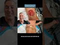 Melanoma Resection and Reconstruction