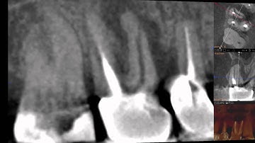 Are fractures visable on a CBCT scan?