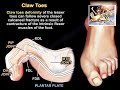 Claw Toe & More - Everything You Need To Know - Dr. Nabil Ebraheim