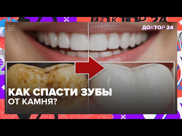 ПОЧЕМУ У ВАС БЫСТРО ОБРАЗУЕТСЯ ЗУБНОЙ КАМЕНЬ, А У ДРУГИХ НЕТ? | Доктор 24