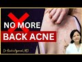 Back Acne Treatment | पीठ पर मुहांसो का इलाज | Back Acne Removal | Causes | Truncal Acne | Satya