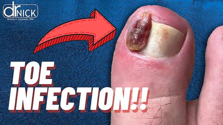 UNREAL TOENAIL INFECTION REQUIRES SURGERY! 😱 | Dr. Nick Campitelli
