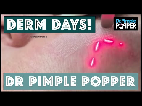 Derm Days With Dr. Pimple Popper!