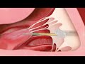 Transcatheter Mitral Valve Repair (Medical Animation)