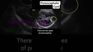 porencephalic cyst on ultrasound #radiology #pregnant #ultrasound #pregnancyscan