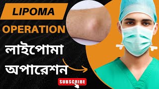 🎓 Lipoma Excision: Step-by-Step Surgical Technique | Trust Medical | লাইপোমা অপারেশন