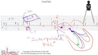 ECG Interpretation Tutorial   ChalkTalk 243   Advanced Level Vietsub