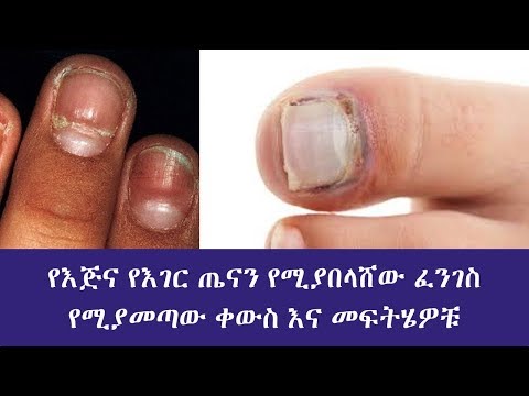 ቪዲዮ: ያልበሰለ የጣት ጥፍር እንዴት እንደሚታጠብ 10 ደረጃዎች (ከስዕሎች ጋር)