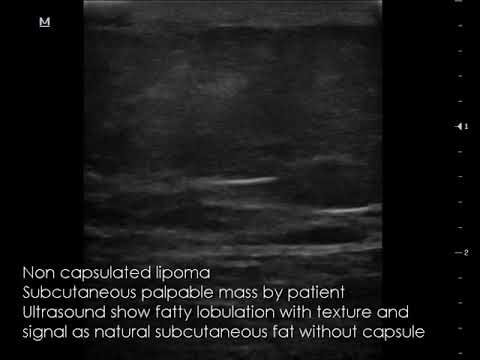 CASE 661 Non capsulated lipoma