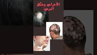 امراض تساقط الشعر ( داء الثعلبة )  Alopecia areata