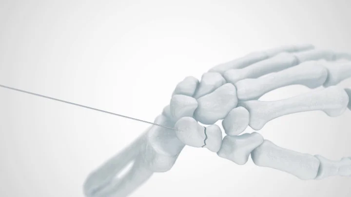 2.5 CAPTIVATE Screw Scaphoid Fracture