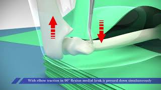 Supracondylar Fracture in Children(Percutaneous  reduction technique)