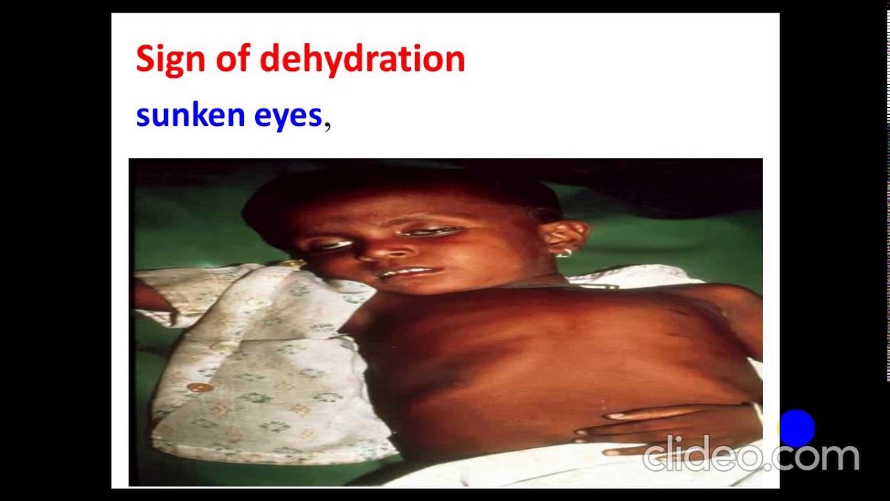 Diarrhea and Irritable Bowel Syndrome. By Dr. Dheyaa Jabbar