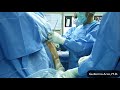 Primary Frozen Shoulder Syndrome Arthroscopic Capsular Release