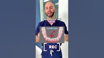Adult Invisalign Transformation in Just 6 Months!
