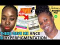 THE TRUTH ABOUT MY HYPERPIGMENTATION DARK SPOTS AND ACNE SCARS! I DID IT TO MYSELF 😩😩| JWILLSCOOL