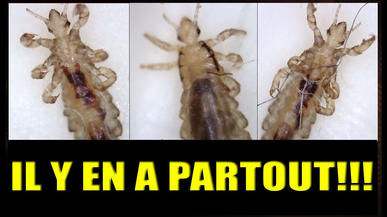 POUX Endoscope expérience - Il y en PARTOUT !!! - YouTube