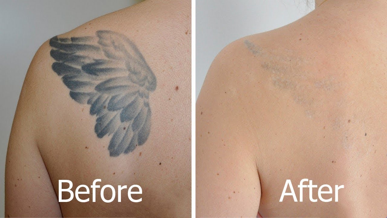 4. Laserless Tattoo Removal - wide 7