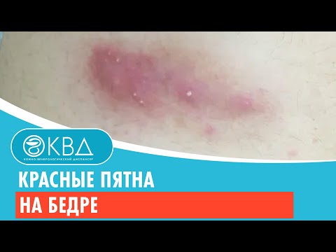 😐 Красные пятна на бедре. Клинический случай №314