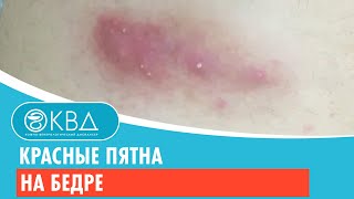 😐 Красные пятна на бедре. Клинический случай №314