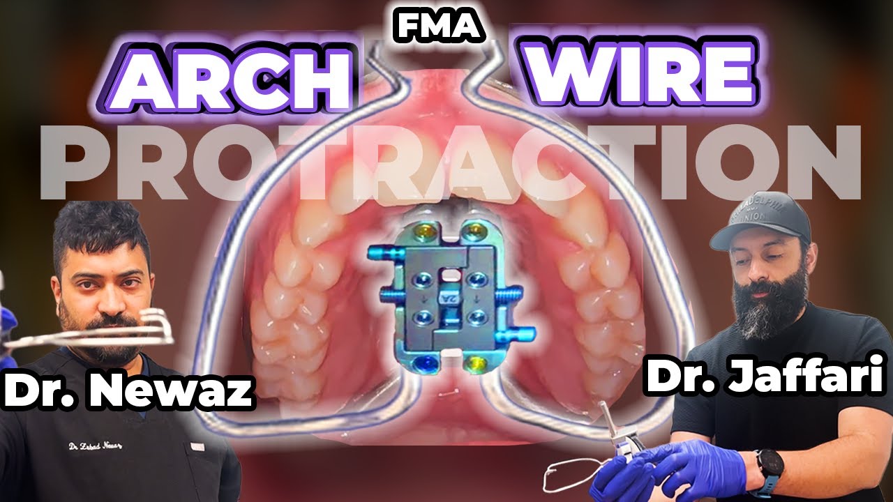 FMA (Close Up Look) Protraction Wire Explained