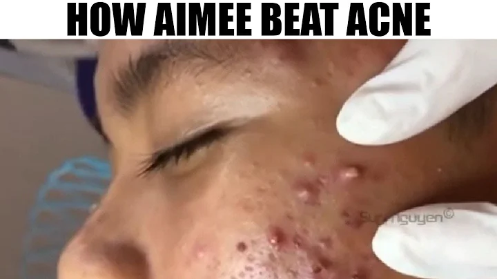 How Aimee Bear Cystic Acne, Dermatology & Blackheads