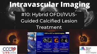 Watch Live #10: Hybrid OFDI/IVUS-Guided Calcified Lesion Treatment