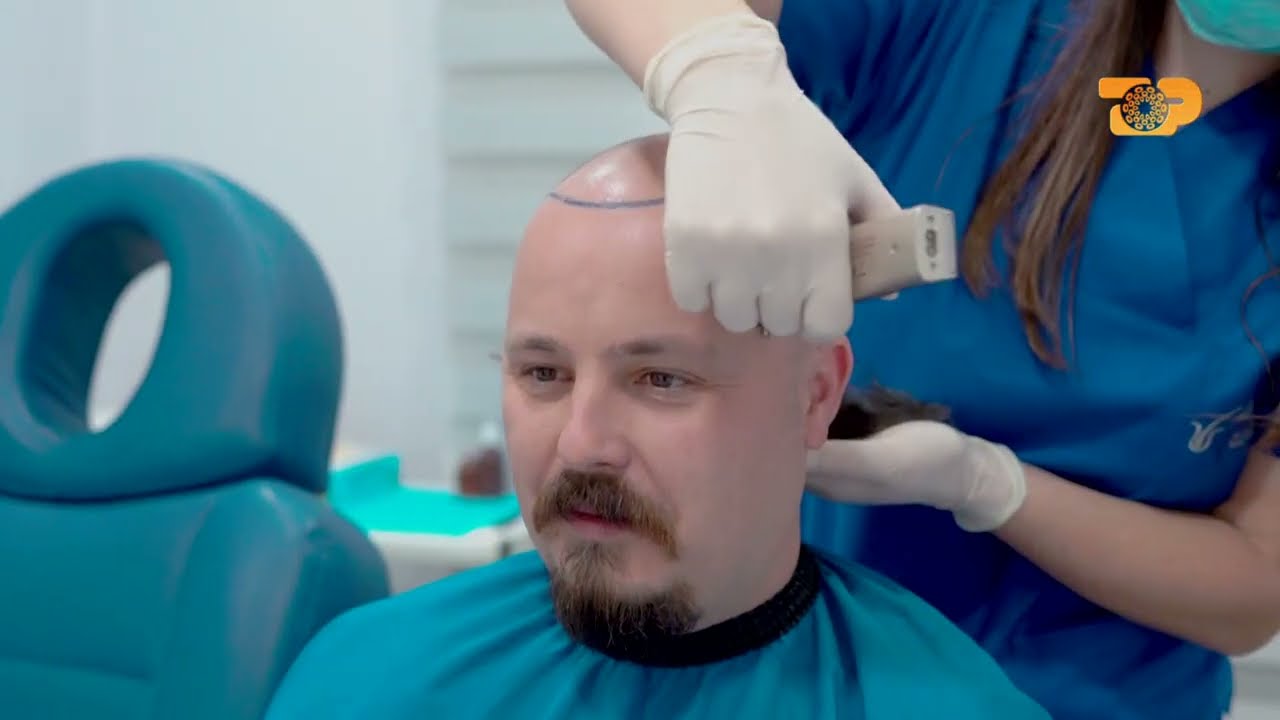 Si kryhet procedura e mbjelljes së flokëve? Gazetari vendos të mbjellë flokët e tij–E Diell 23.10.22