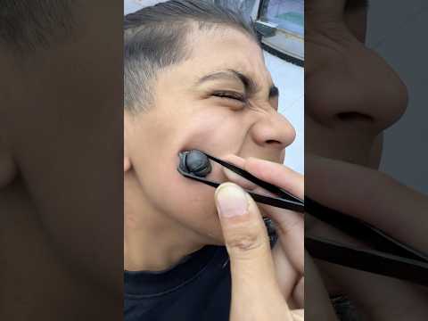 ازالة الخازوق المتسلطن من الخد       