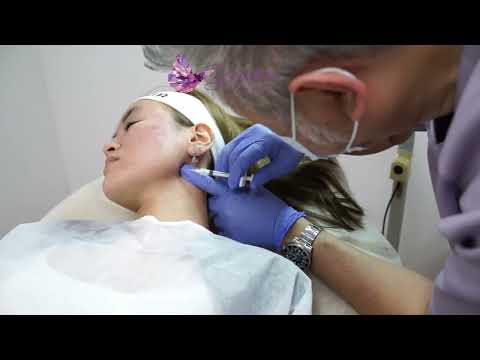 Mandibular Angle Biostimulator Injections