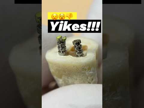 Mandibular Molar Access Tip 