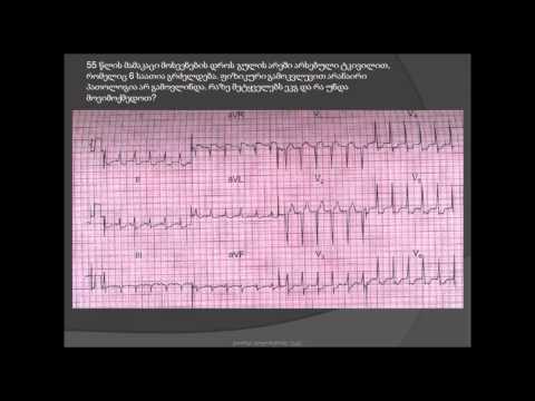 ეკგ / არასტაბილური სტენოკარდია (პრეინფარქტული სტენოკარდია) / გულის იშემიური დაავადება