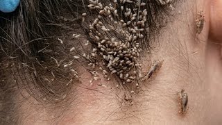 Tips Merawat Rambut Sehat & Bersih Bebas Masalah Kulit Kepala #part025