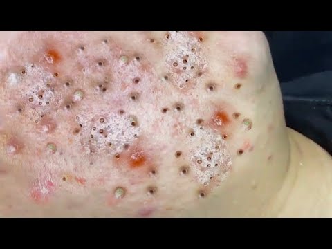 Big Cystic Acne Blackheads Extraction Blackheads & Milia, Whiteheads  Removal Pimple Popping # 3786 - YouTube