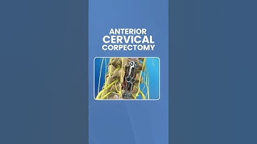 Cervical Corpectomy Explained #shorts