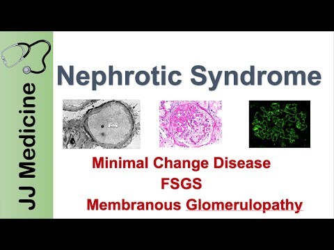 Video: Je nefritični sindrom glomerulonefritis?