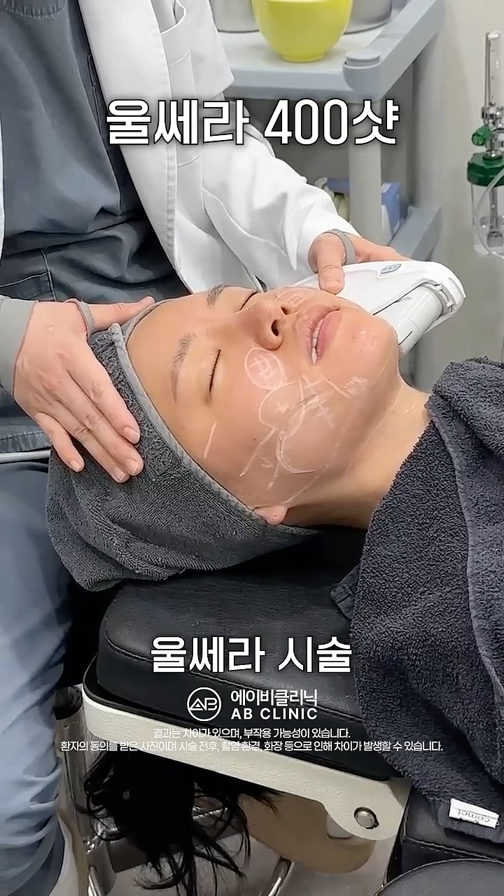 울쎄라 400샷 효과
