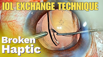 IOL Exchange technique, Broken Haptic - Dr. Deepak Megur