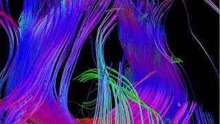 Diffusion Tensor Tractography DTI MRI 5 - William Edward Hahn