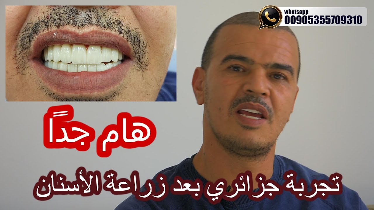 زراعة كامل أسنان الفكين لشاب جزائري لديه مصنع حلويات في تيبازا