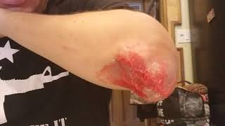 Incredible exploding Cyst popping pimple tophaceous gout nodule