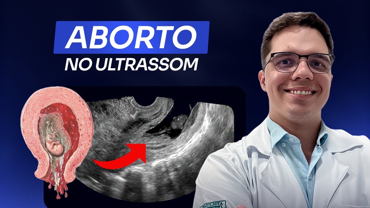 Abortamento: como diagnosticar no ultrassom da forma correta