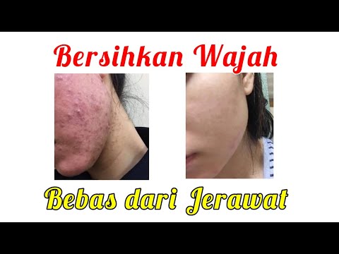 hanya-1-malam-atasi-jerawat-secara-alami-i-cara-merawat-wajah-secara-alami