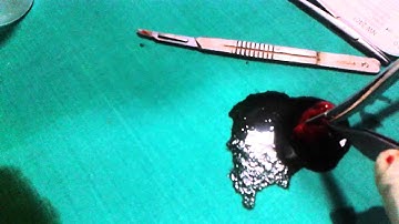 Metastatic Lymph node (Classical look) - dr.t.varun raju