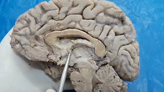 Third Ventricle- Neuroanatomy