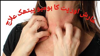 Homeopathic treatment for Scabies and Prickly Heat (خارش اور گرمی دانوں کا ہومیو پیتھک علاج)