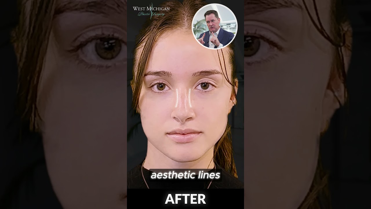 Rhinoplasty Case Analysis - 20 Year Old - Dr. Scott Holley - Michigan's Favorite Rhinoplasty Surgeon