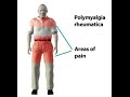 Polymyalgia Rheumatica